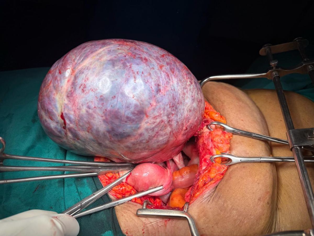 Large ovarian tumour excision — open surgery with retractors
